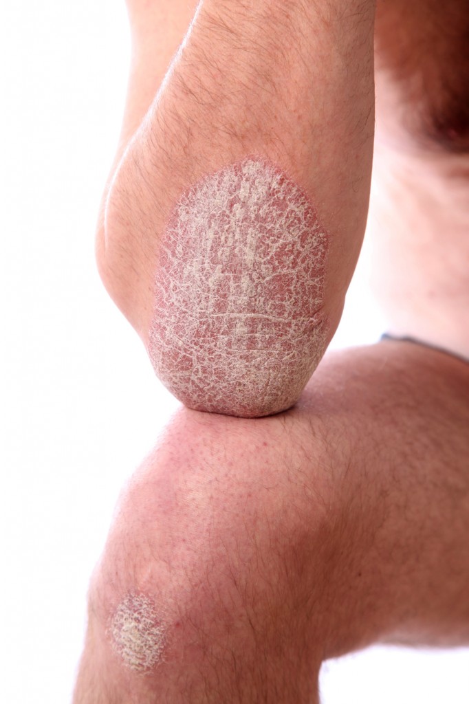 Schuppenflechte - Psoriasis an Armen und Beinen