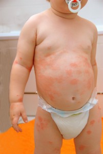 Atopische Dermatitis: Worauf sollten Eltern achten?
