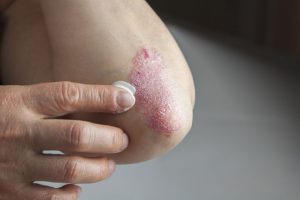 Psoriasis am Ellenbogen